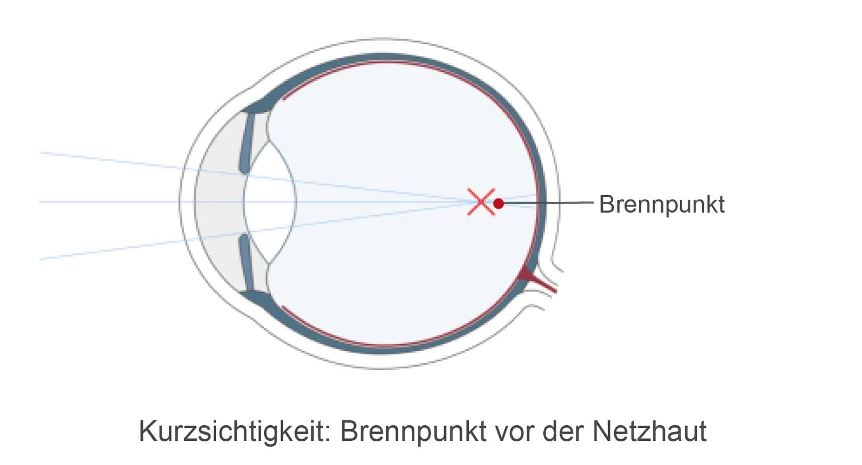 Das kurzsichtige Auge