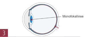 Implantation der Multifokallinse