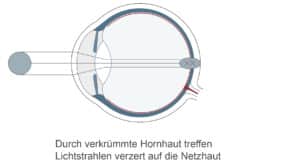 HORNHAUTVERKruemmung_02