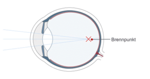 Das kurzsichtige Auge