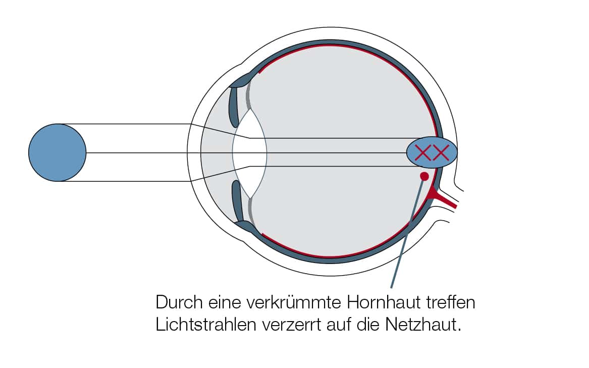 Hornhautverkrümmung: Unterschiedlich starke Wölbungen