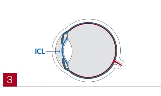 ICL im Auge