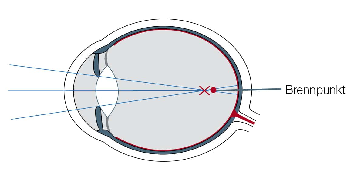 Das kurzsichtige Auge