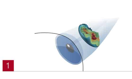 LASIK Abbildung