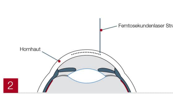 LASIK beschriftete Abbildung
