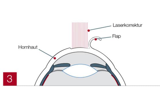 LASIK beschriftete Abbildung