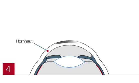 Hornhaut im Auge (PRK)