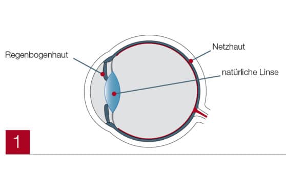 Auge beschriftet (Trifokallinse)