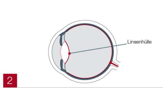 Linsenhülle im Auge (Trifokallinse)