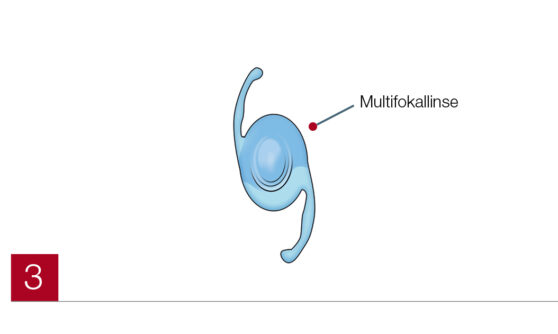 Multifokallinse Abbildung