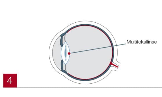 Multifokallinse im Auge