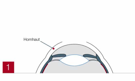 Hornhaut im Auge (PRK)