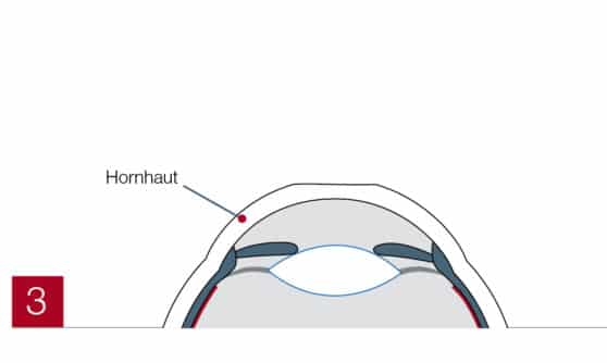 Hornhaut beschriftet (PRK)