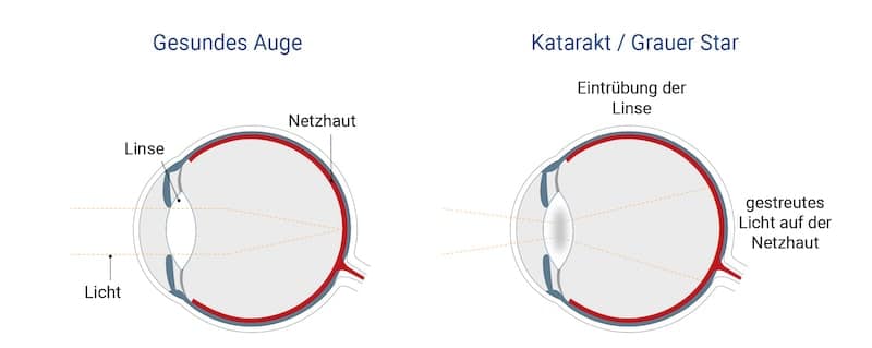 Grauer Star Erklärungsgrafik