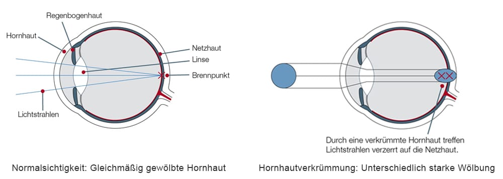 Hornhautverkrömmung Infgrafografik