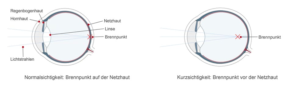 Kurzsichtigkeit Infografik