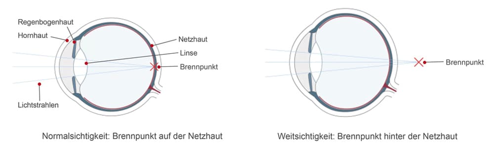 Weitsichtigkeit Infografik