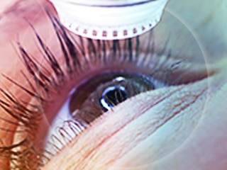augenlasern