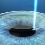 augenlasern