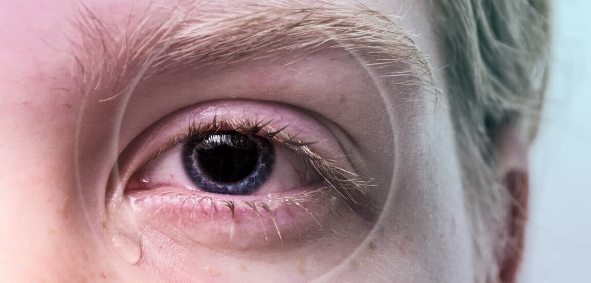 Augenprobleme – was tun bei Augenbeschwerden? - euroeyes.de