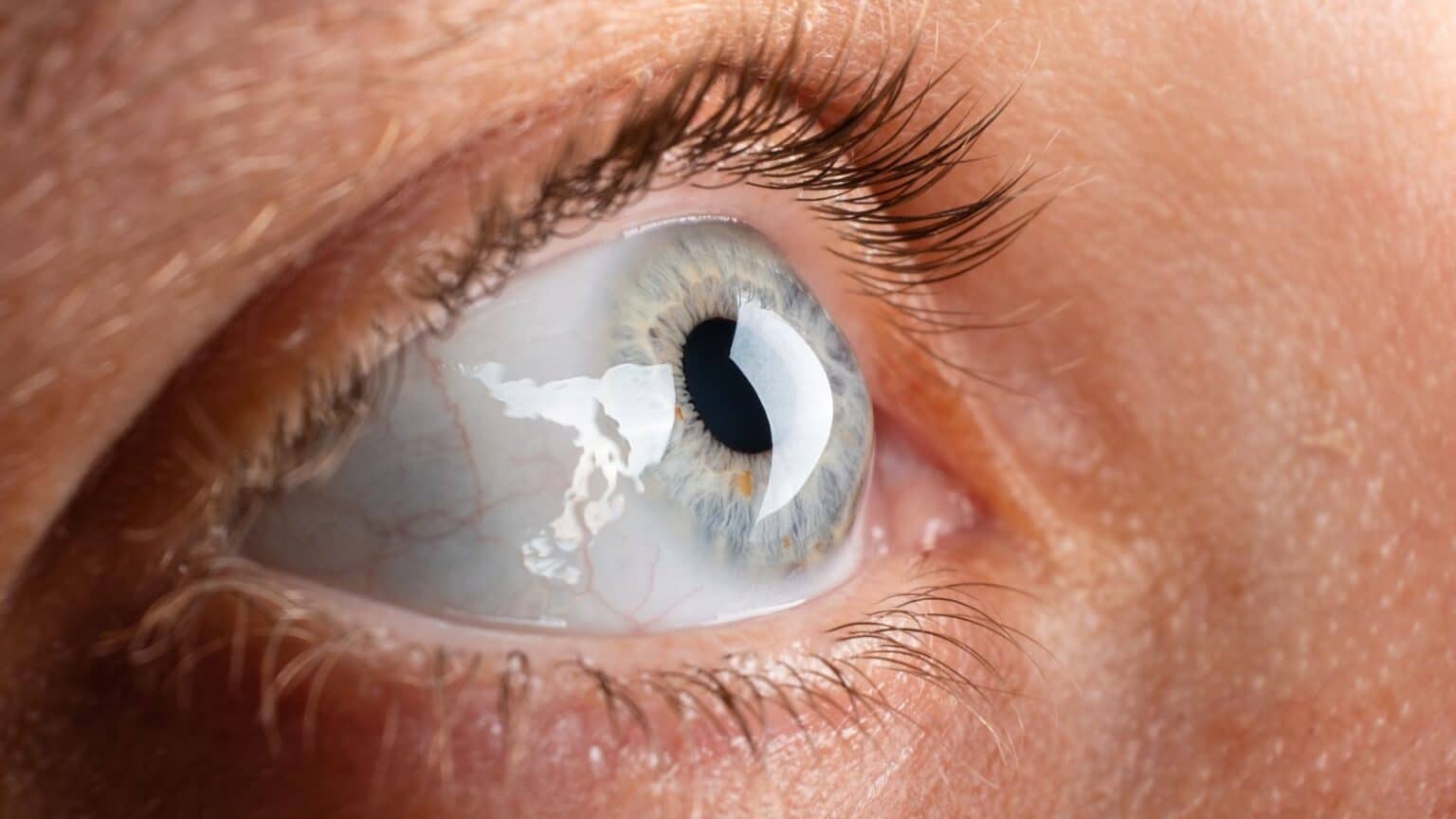 Hornhautverkrümmung Wissenswertes zum Astigmatismus euroeyes.de