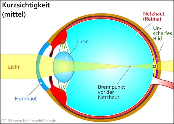 Was bedeutet Dioptrien - Kurzsichtigkeit
