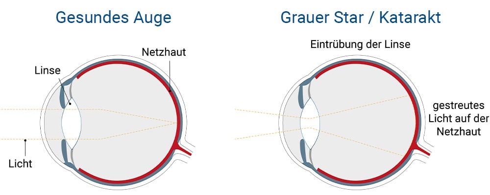 Grauer Star Erklärungsgrafik