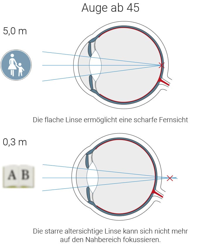 Die Ursache der Altersweitsichtigkeit verstehen