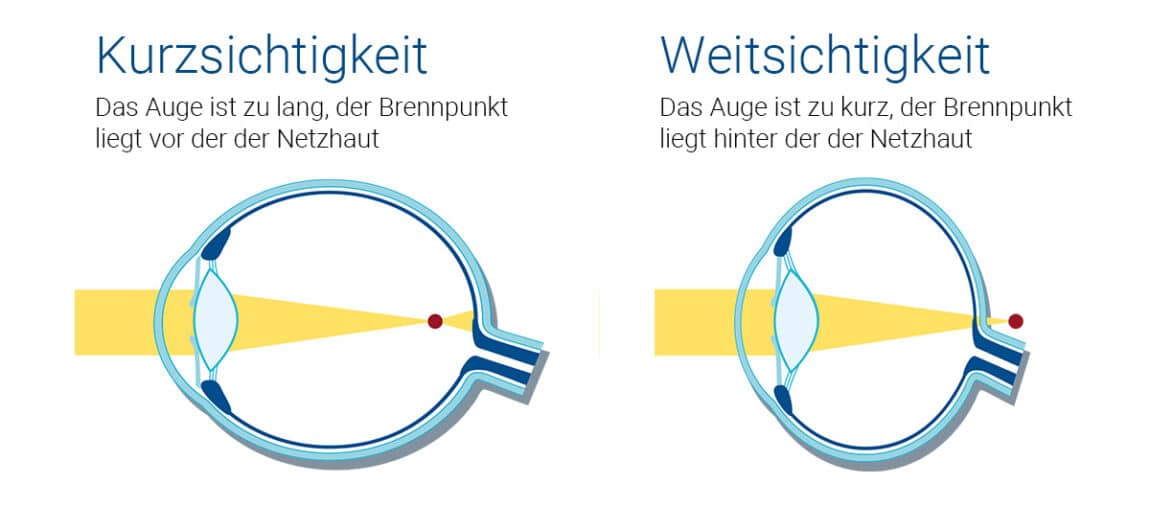 Kurzsichtig und weitsichtig Unterschiede einfach erklärt