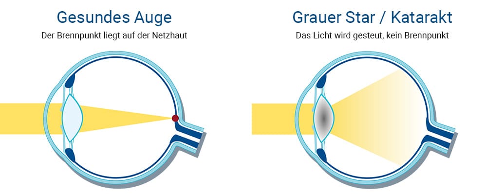 Grauer Star Schemazeichnung