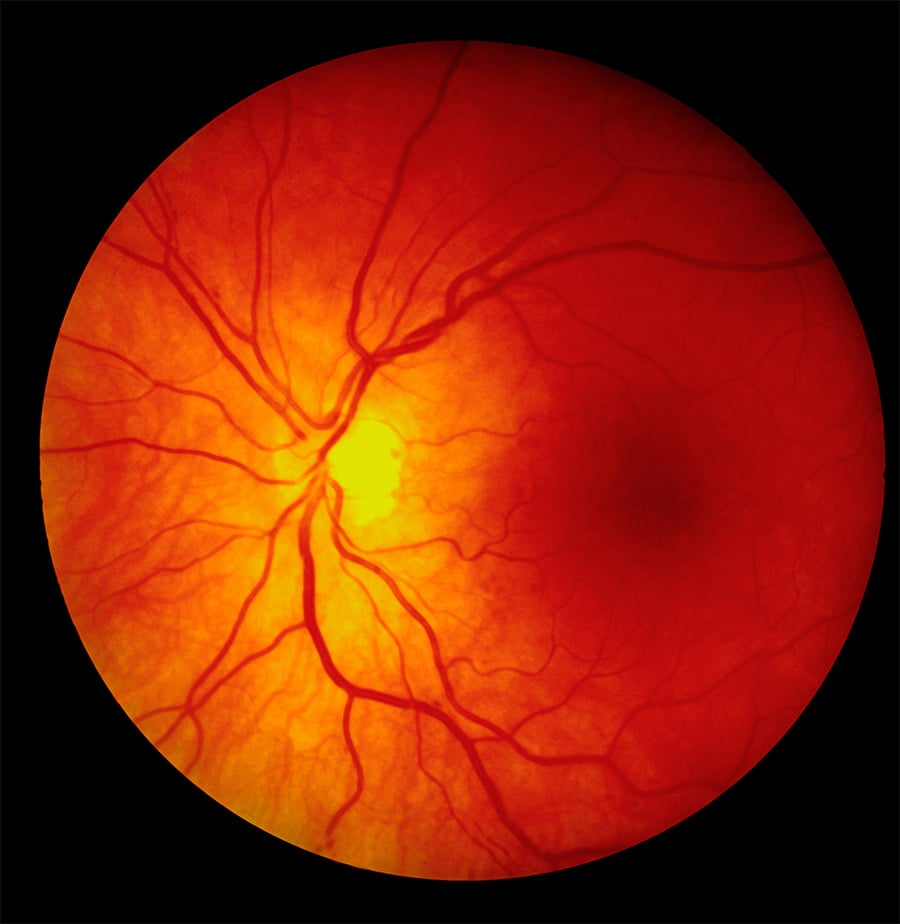 Die Retina