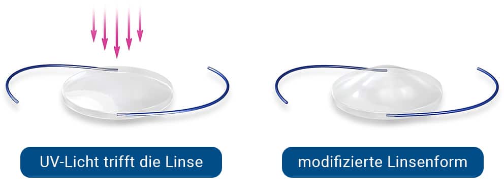 Light Adjustable Lens Linse vorher nachher