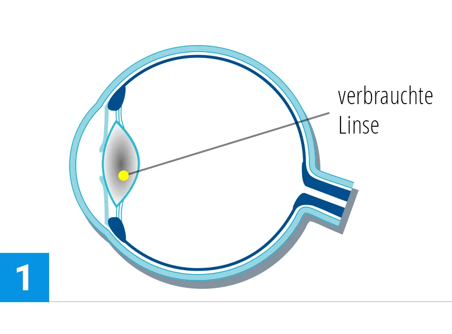 steps verfahren katarakt1