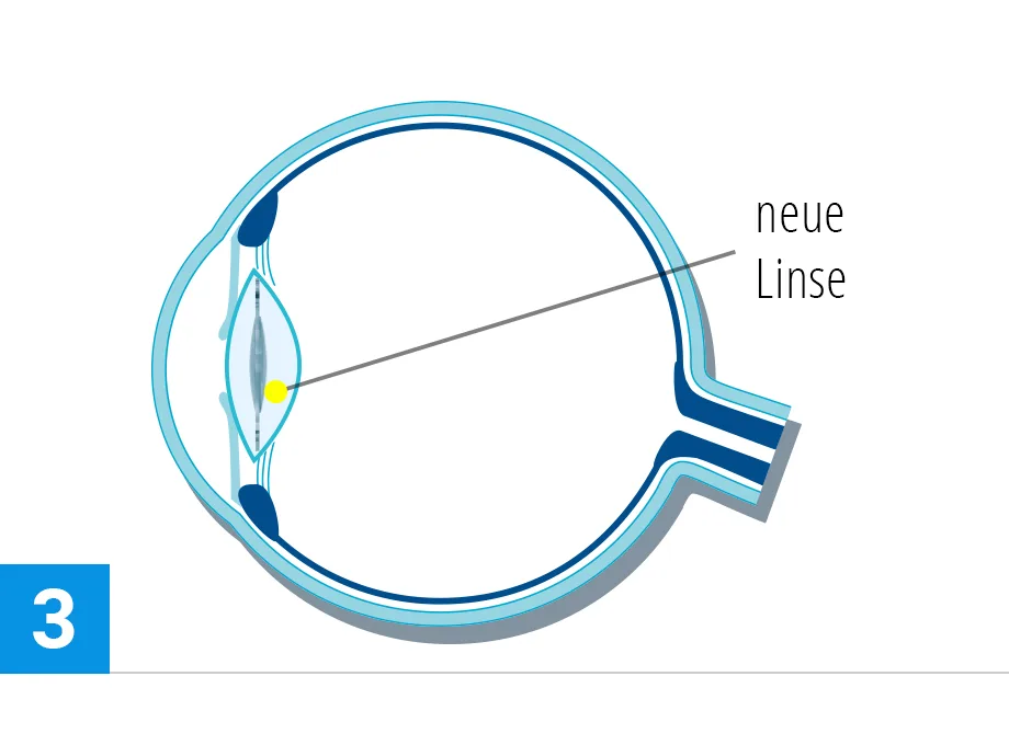 steps verfahren katarakt3