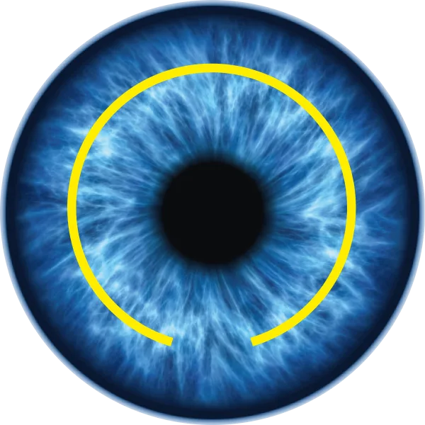 Lasik-Flap Lasik Flap