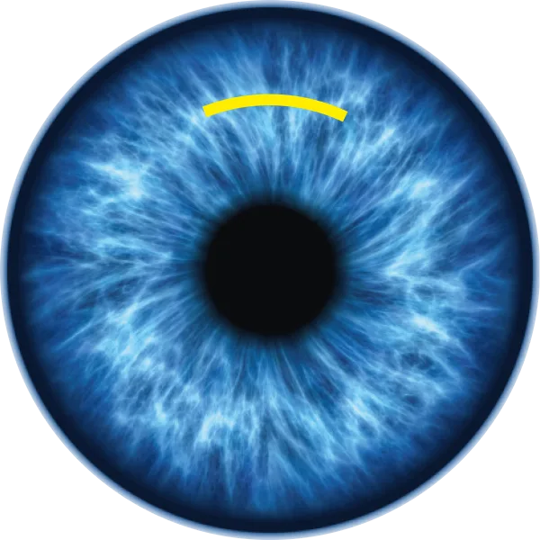 SMILE-minimalinvasiv SMILE minimalinvasiv