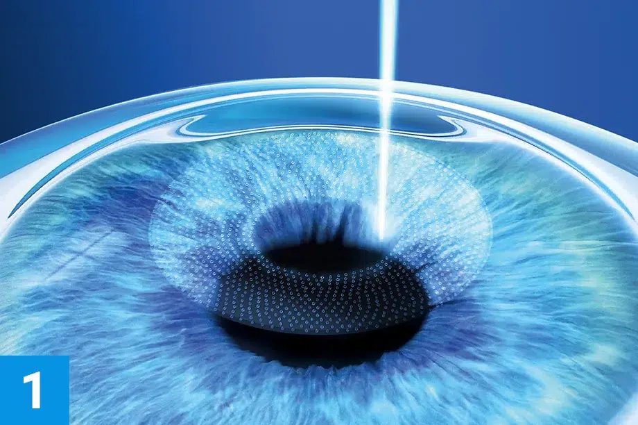 steps verfahren smile1