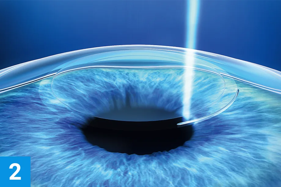 steps verfahren smile2