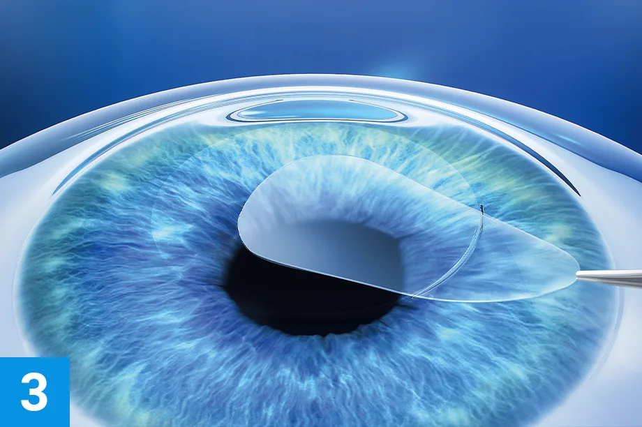 steps verfahren smile3