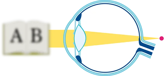 Grafik-Auge-alte-Linse Grafik Auge alte Linse