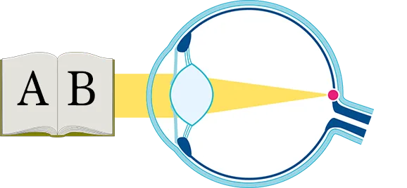 Grafik-Auge-junge-Linse Grafik Auge junge Linse